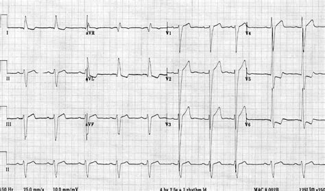 ecg lv strain|left ventricular hypertrophy on ecg.